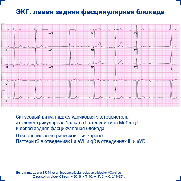 ЭКГ левая задняя фасцикулярная блокада